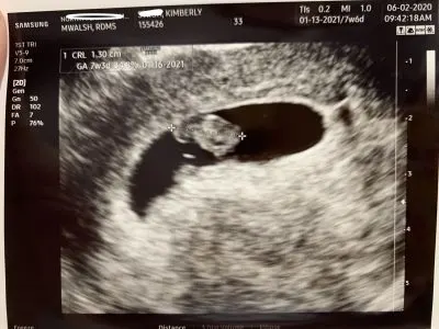 7 Week Ultrasound Photo, 7 Weeks Pregnant Ultrasound Image