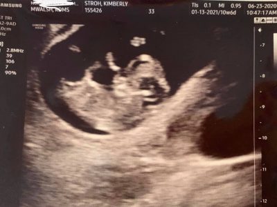 10 week ultrasound, first trimester ultrasound photo, ultrasound image 10 weeks